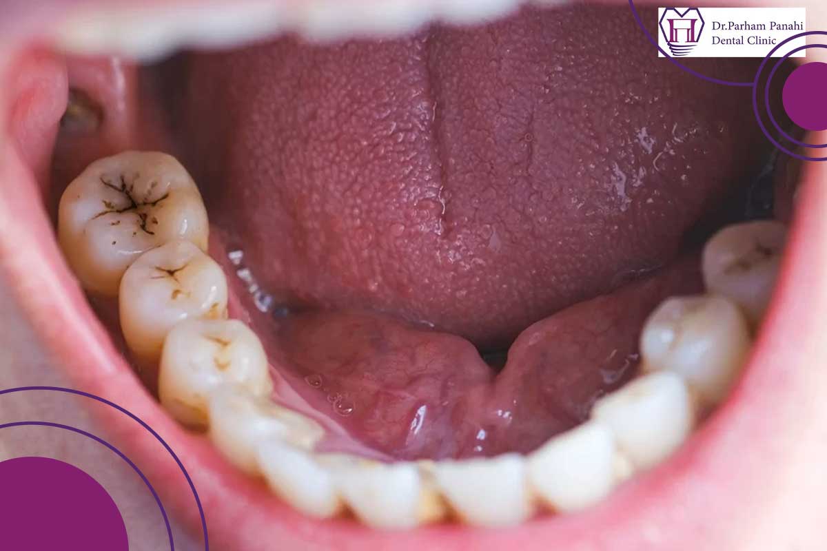 درگیری پالپ (عفونت مرکز حیات دندان)