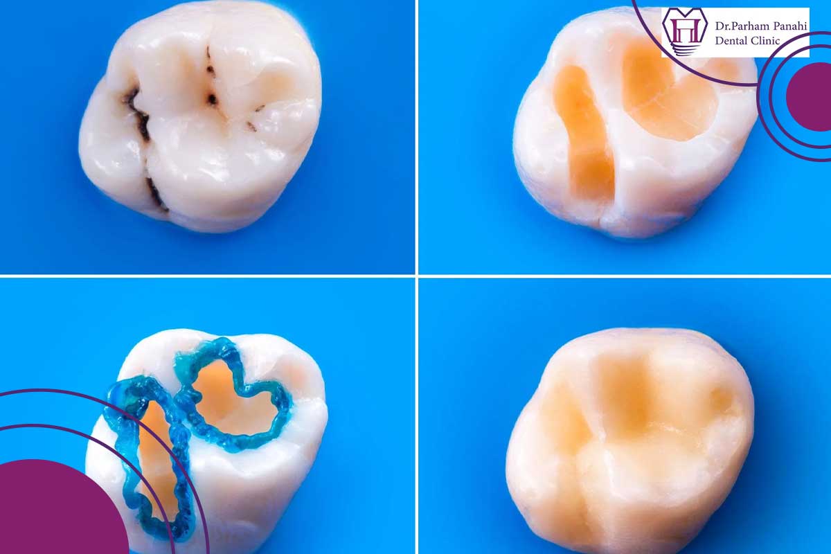 ترمیم شکستن و ریختن دندان پرشده