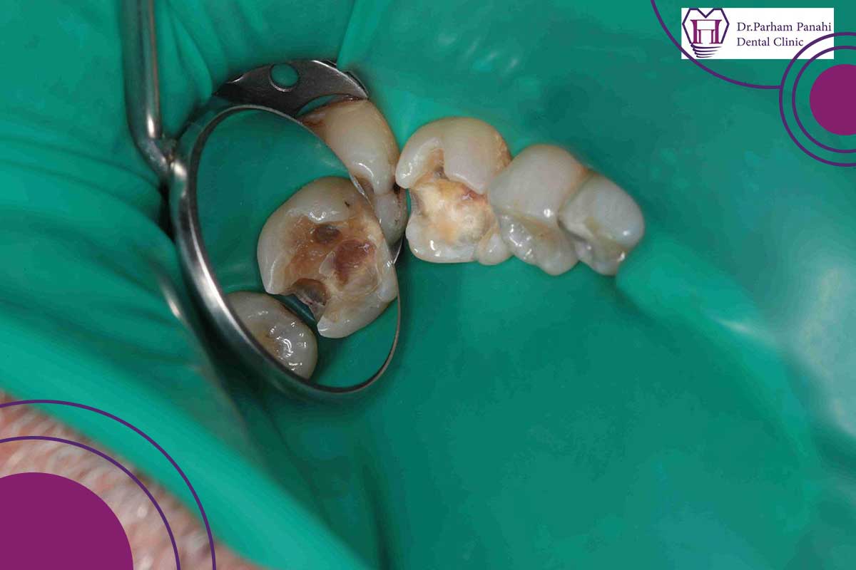 استراتژی‌های درمانی ترمیم دندان افتاده و ریخته شده: وقتی دندان می‌شکند، چه گزینه‌هایی داریم؟
