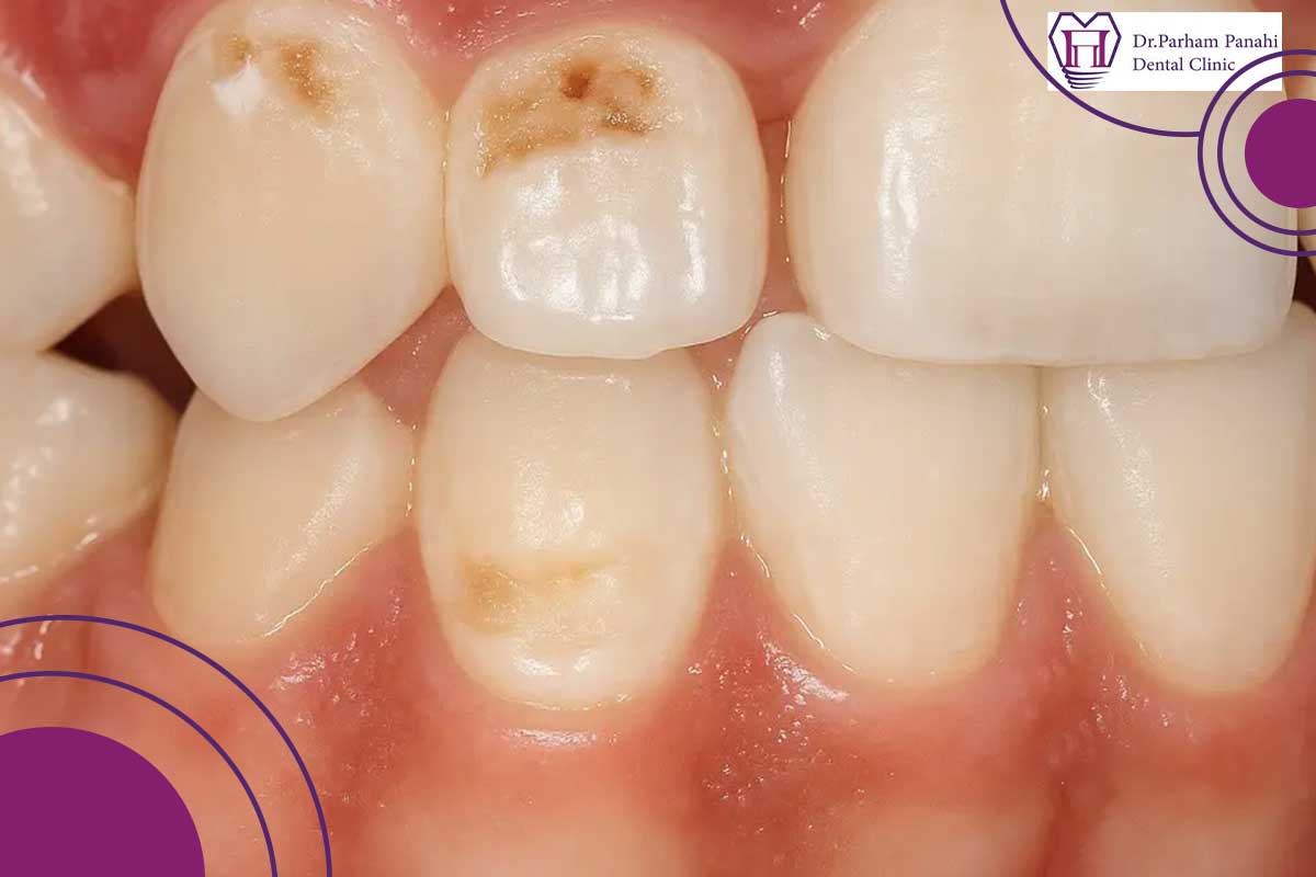 نفوذ به عاج دندان (زنگ خطر حساسیت و درد)