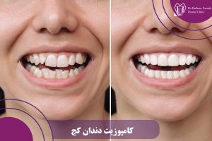 کامپوزیت دندان کج