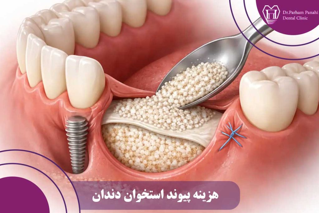 هزینه پیوند استخوان دندان