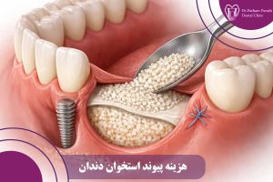 هزینه پیوند استخوان دندان