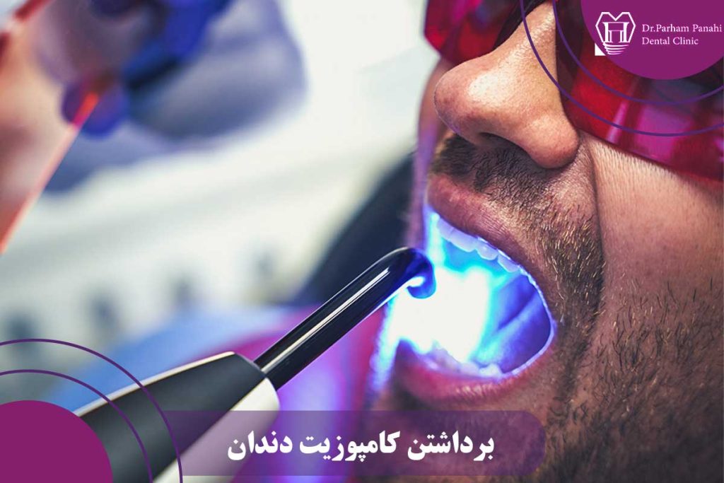 برداشتن کامپوزیت دندان