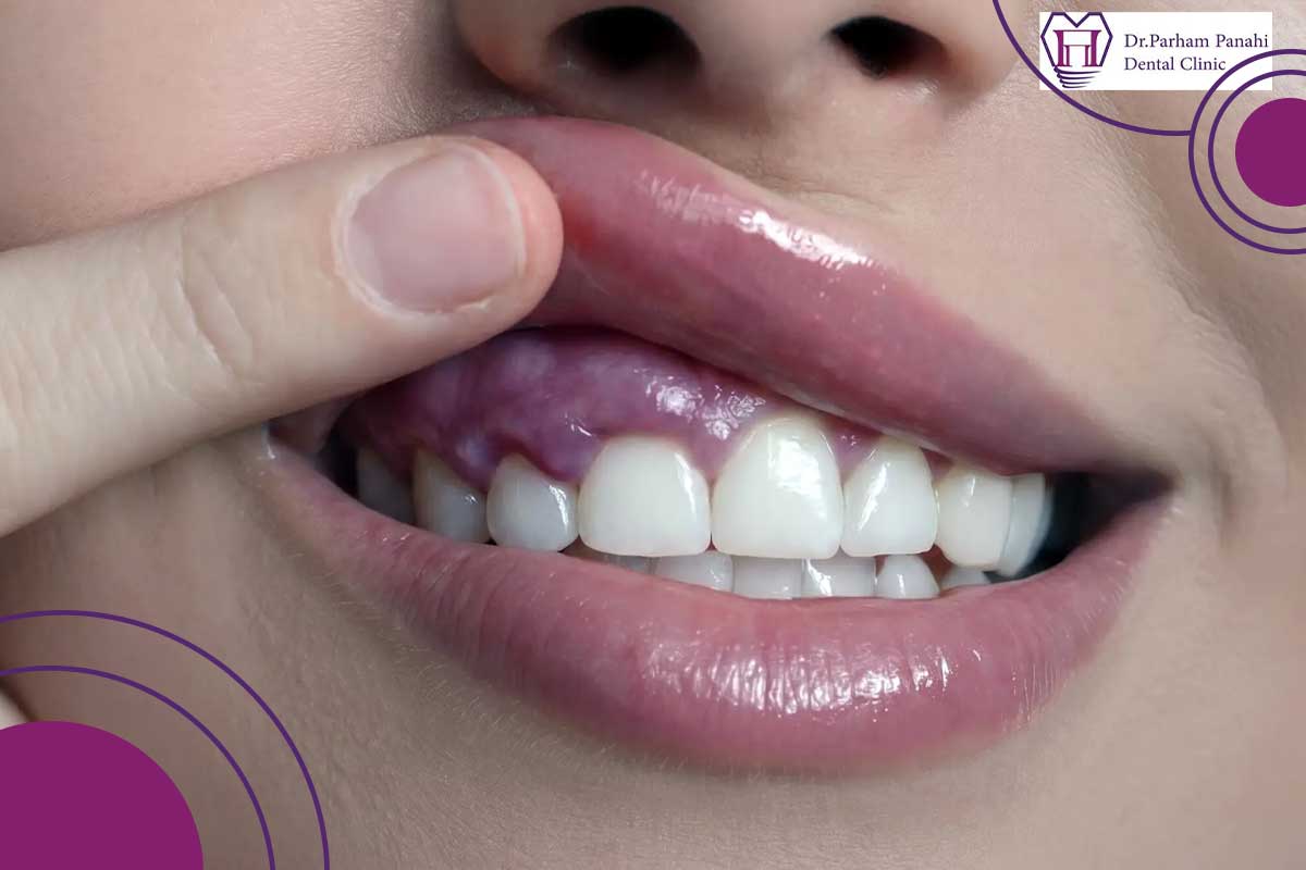 خطرات برداشتن کامپوزیت دندان